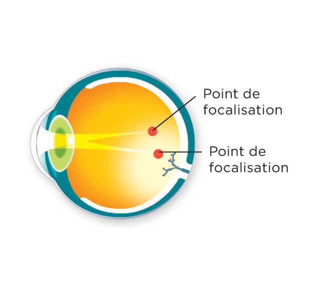 Schéma d'un point de focalisation divisé derrière une rétine