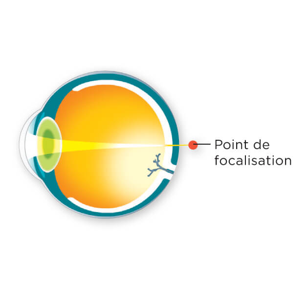 Schéma d'un point de focalisation derrière une rétine