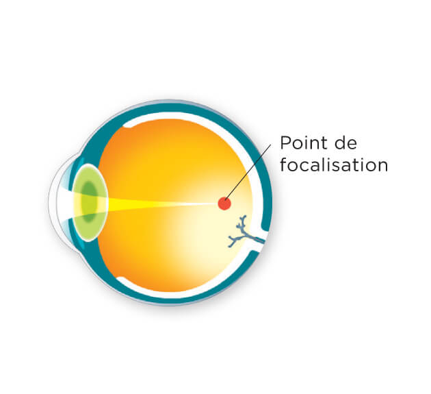 Schéma d'un point de focalisation devant une rétine