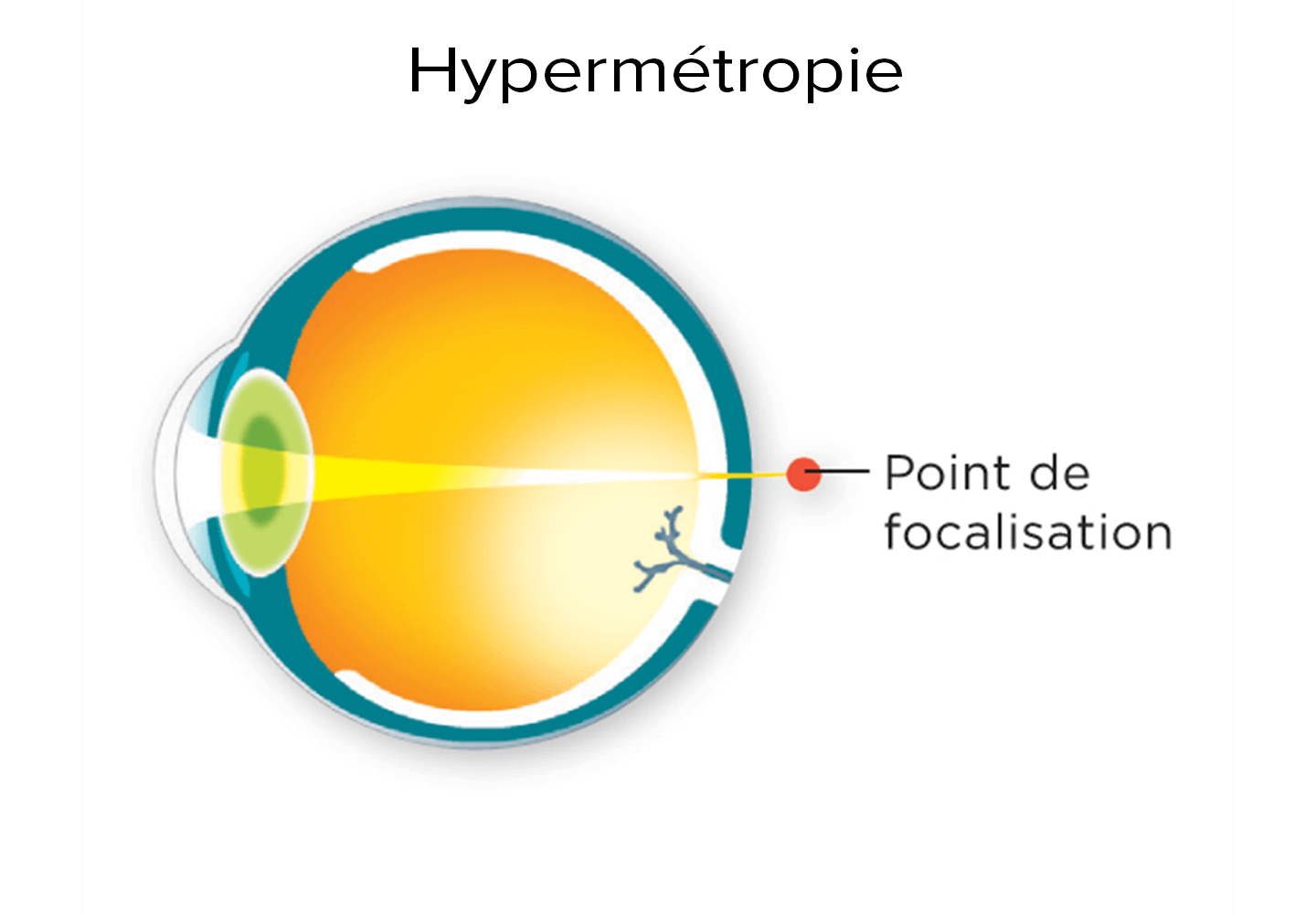 Schéma d'un point de focalisation devant la rétine pour un oeil hypermétrope
