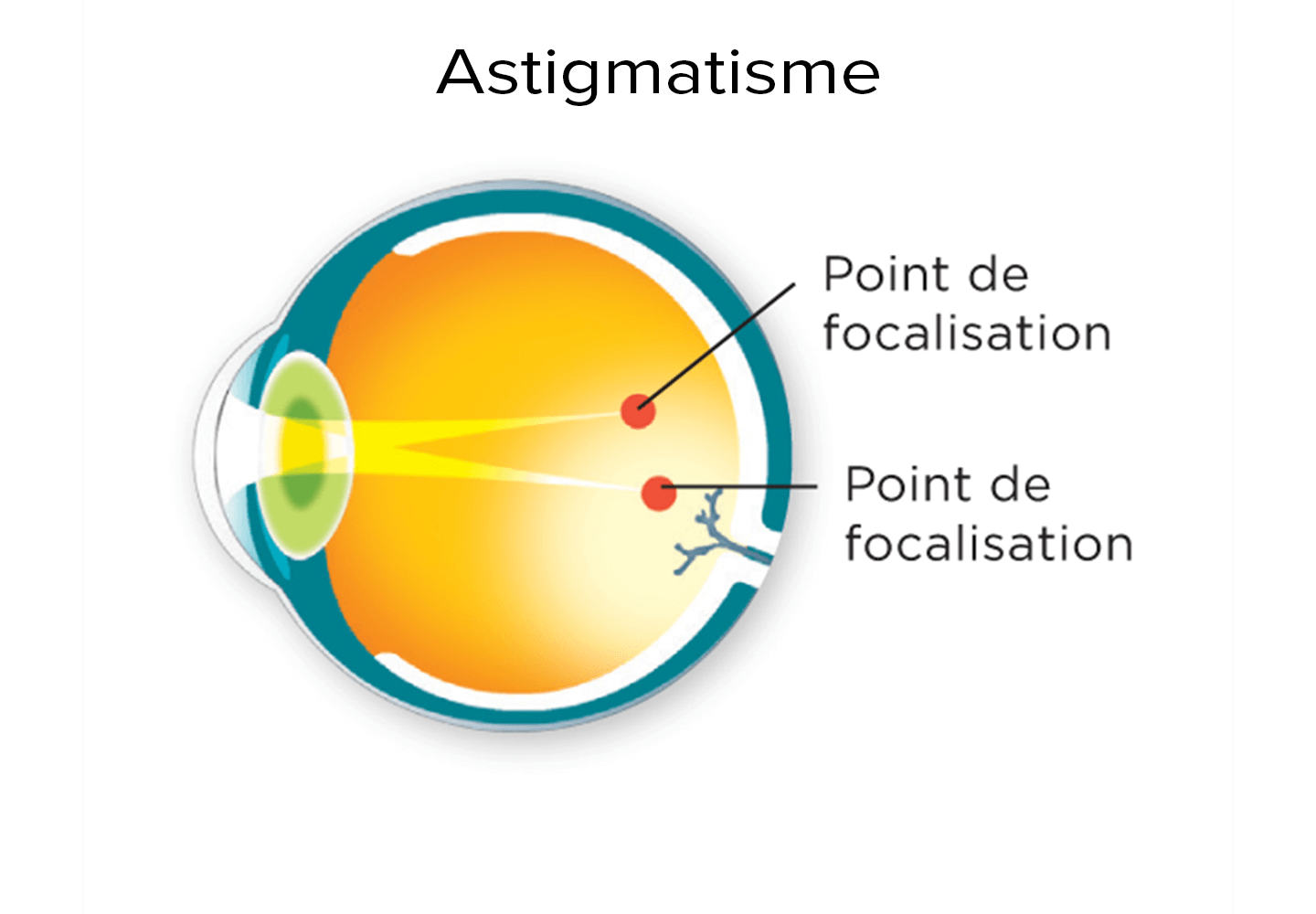Schéma d'un point de focalisation dédoublé la rétine pour un oeil astigmate
