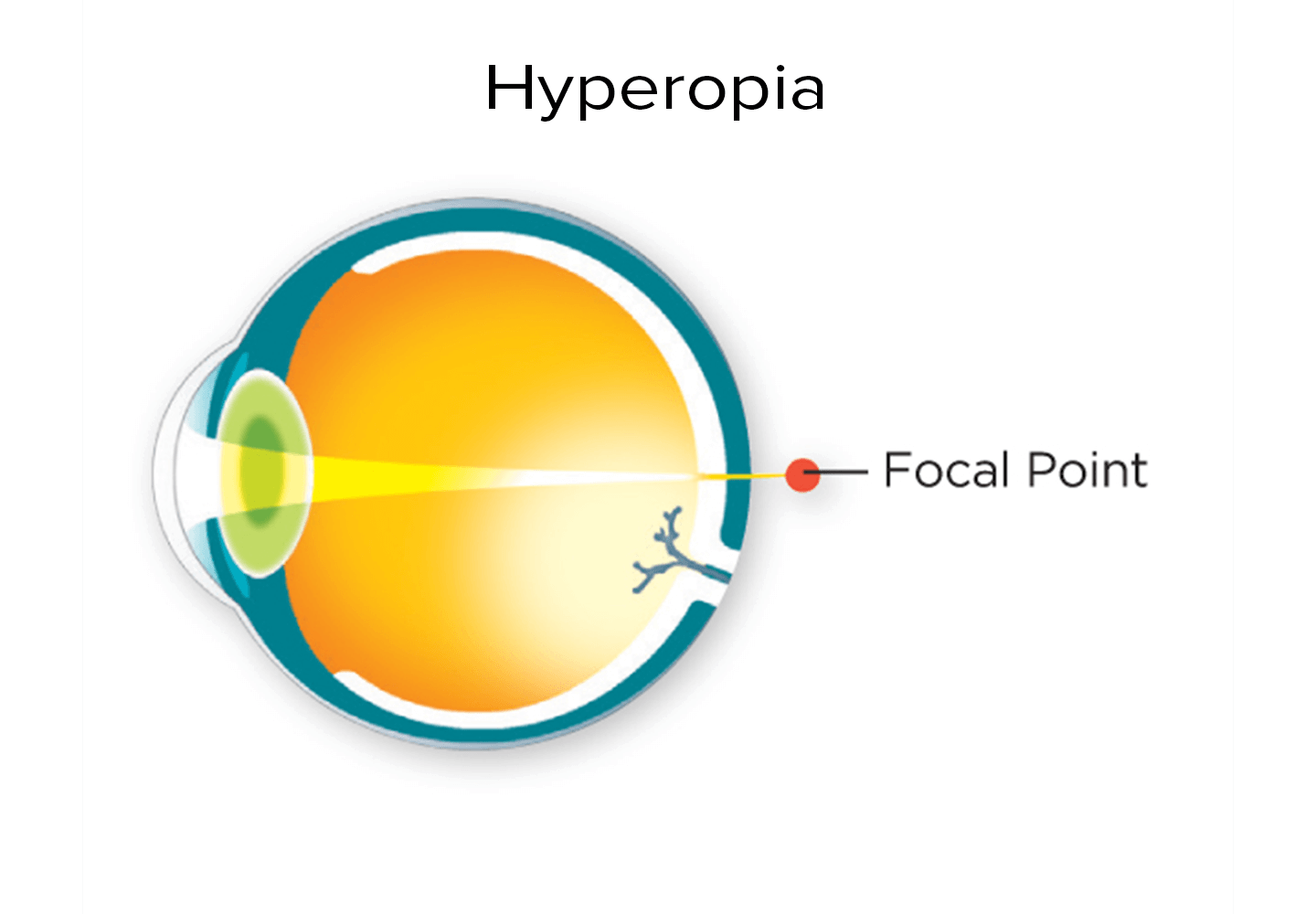Diagram of a focal point in front of the retina for a hyperopic eye