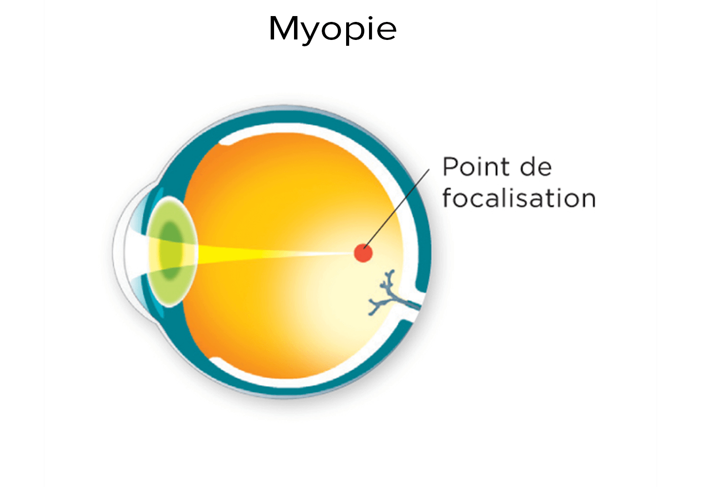 Schéma d'un point de focalisation derrière la rétine pour un oeil myope