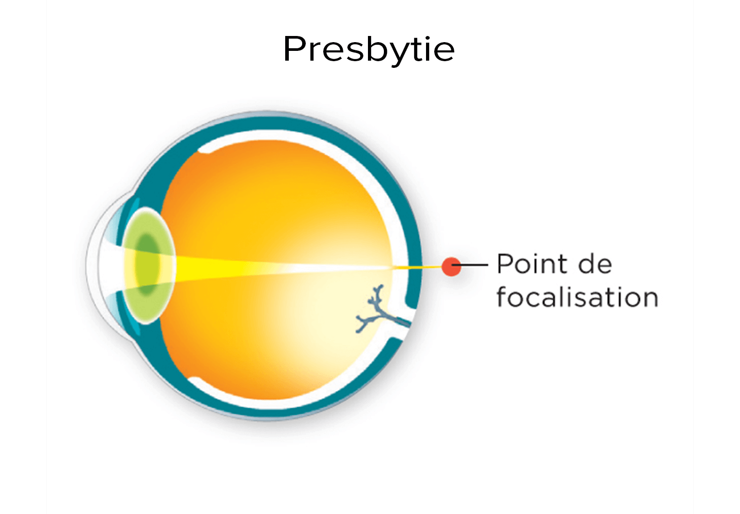 Schéma d'un point de focalisation derrière la rétine pour un oeil presbyte