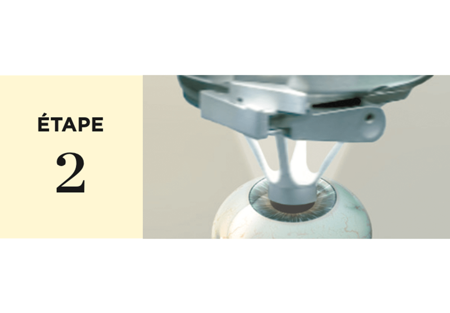 Succion faite sur l'oeil avant la création du flap.