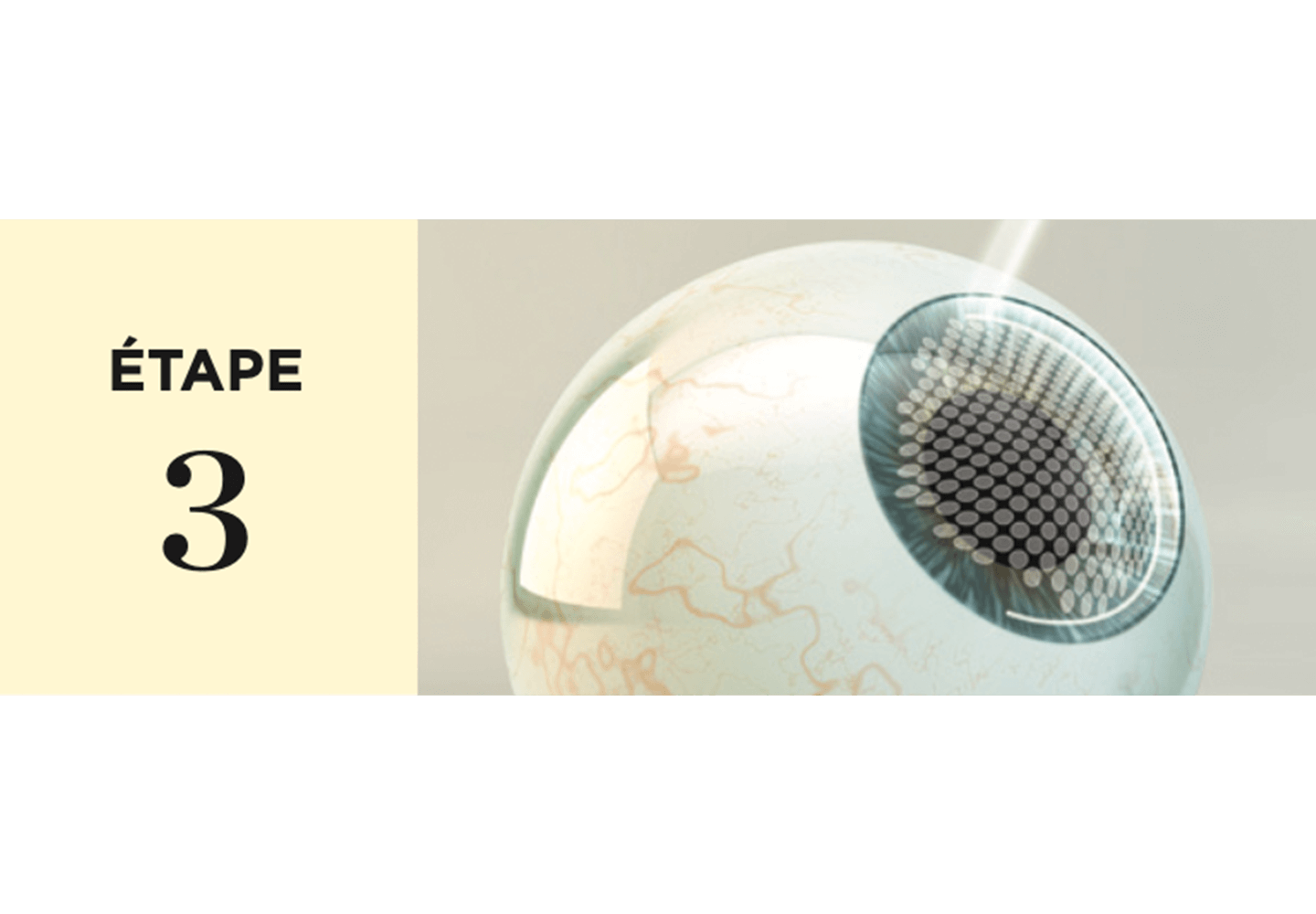 Création du flap par le laser intralase IFS.