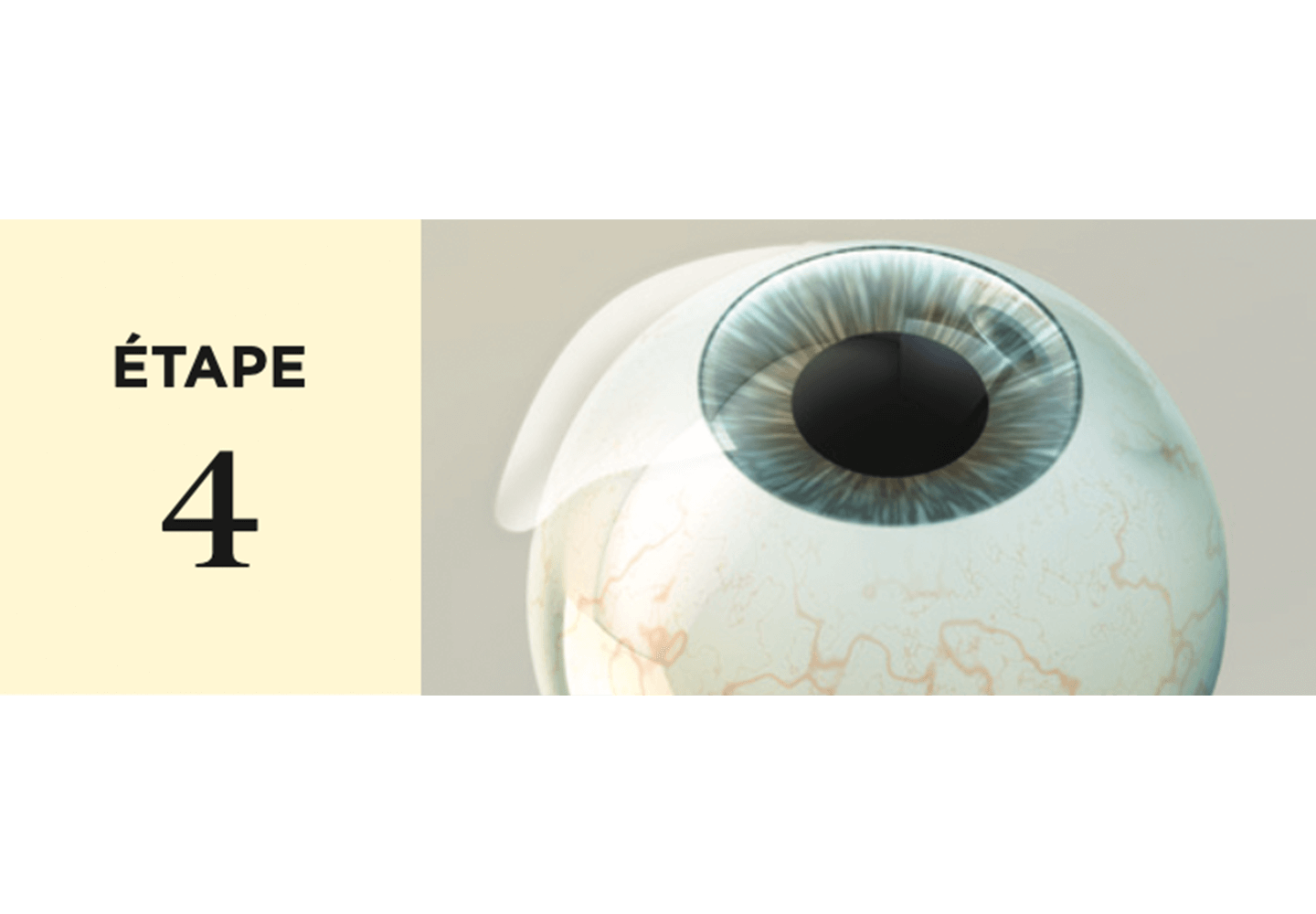 Soulèvement du flap par l'ophtalmologiste.
