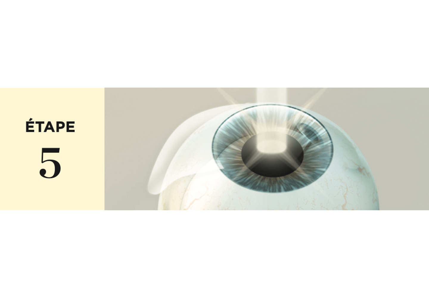 Traitement laser par le laser Schwind Amaris 750s.