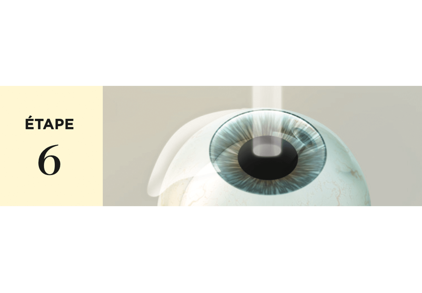 Traitement laser sur la cornée du patient.