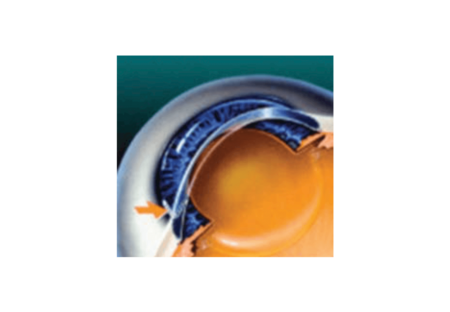 Incision de deux à trois millimètres sur le bord de la cornée