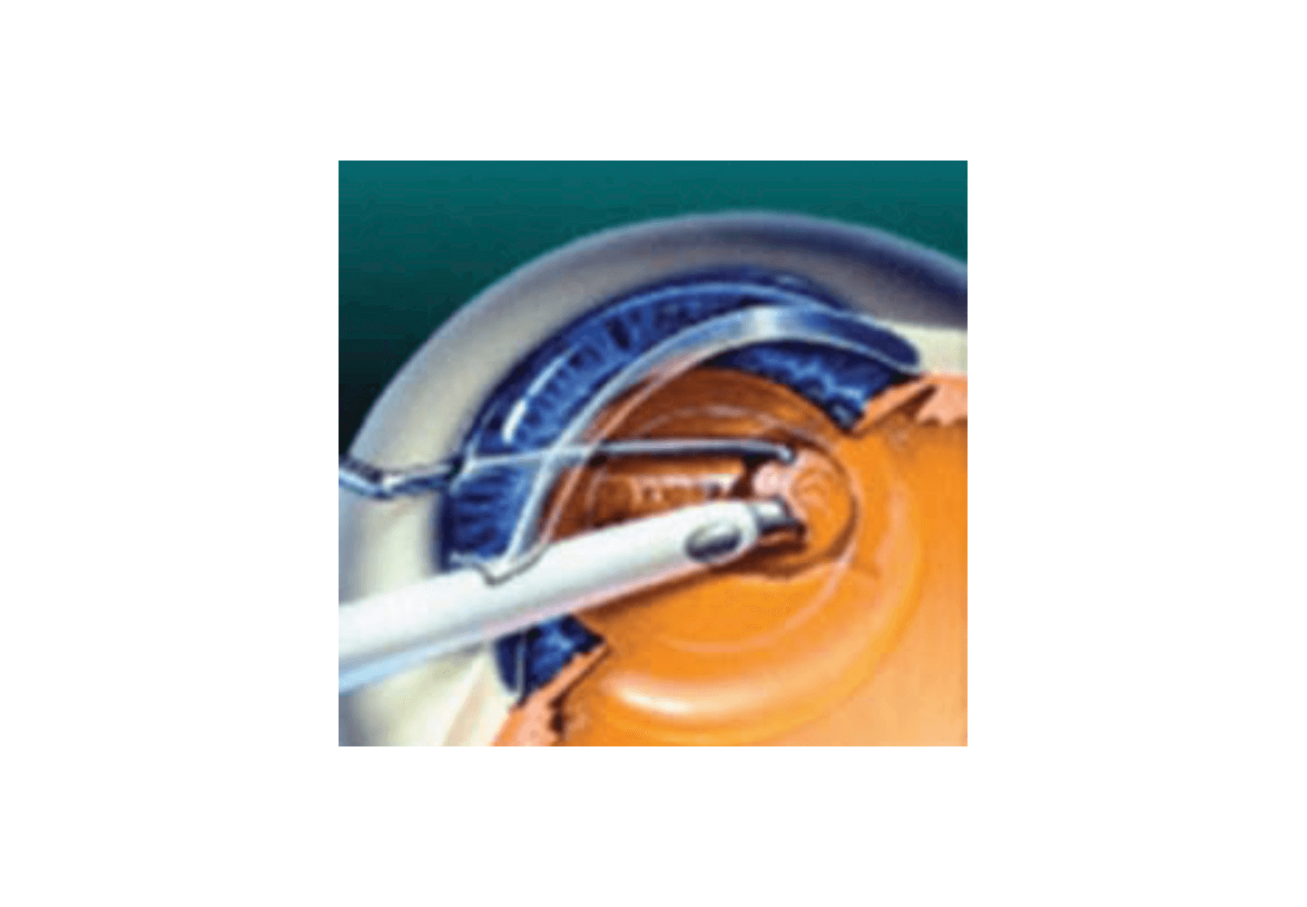 Fragmentation d'un cristallin à l'aide d'un outil à ultra sons