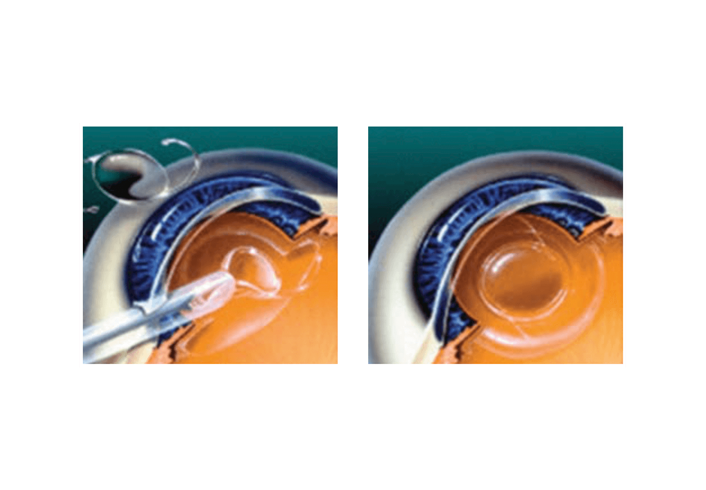 Insertion d'une lentille intraoculaire pliable