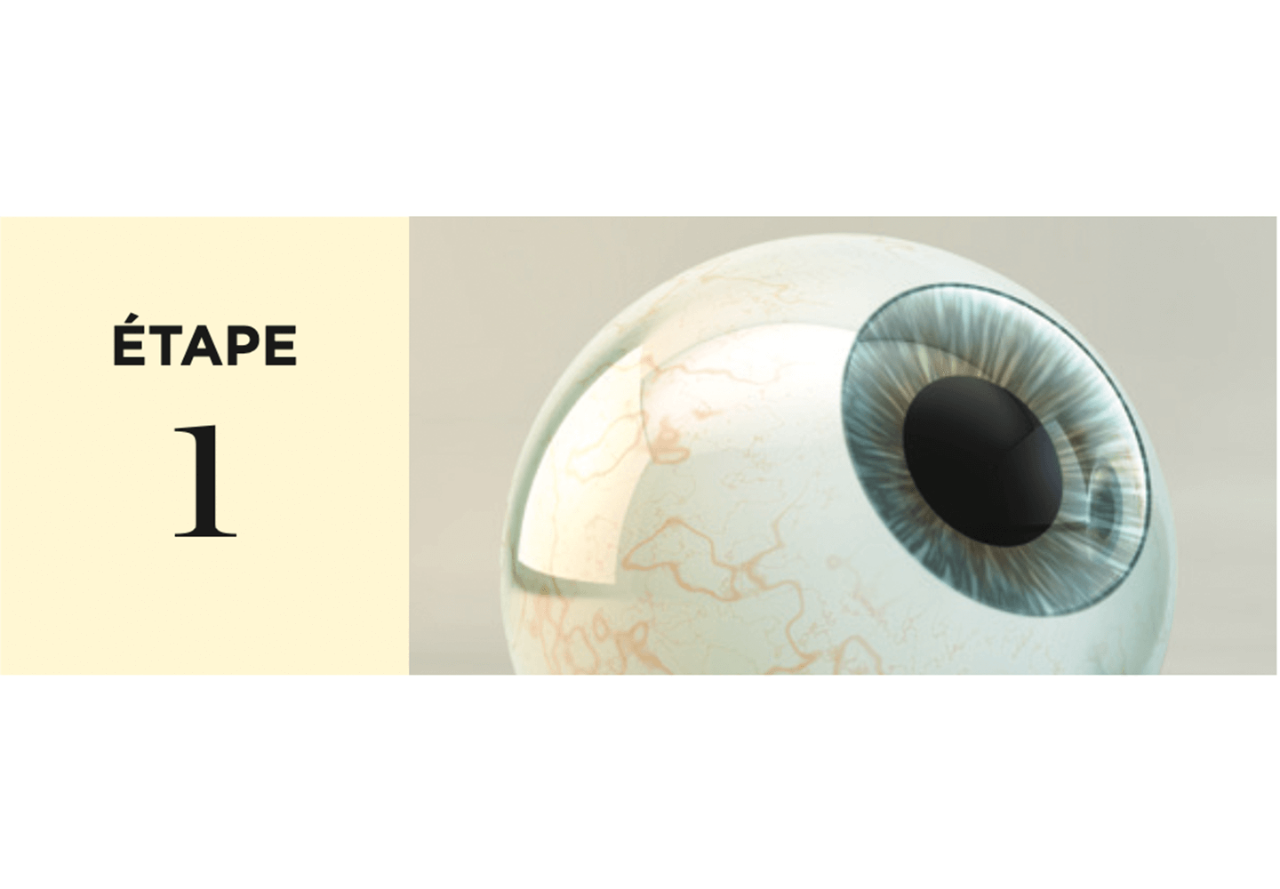 Première étape de la chirurgie laser par ablation de surface PRK