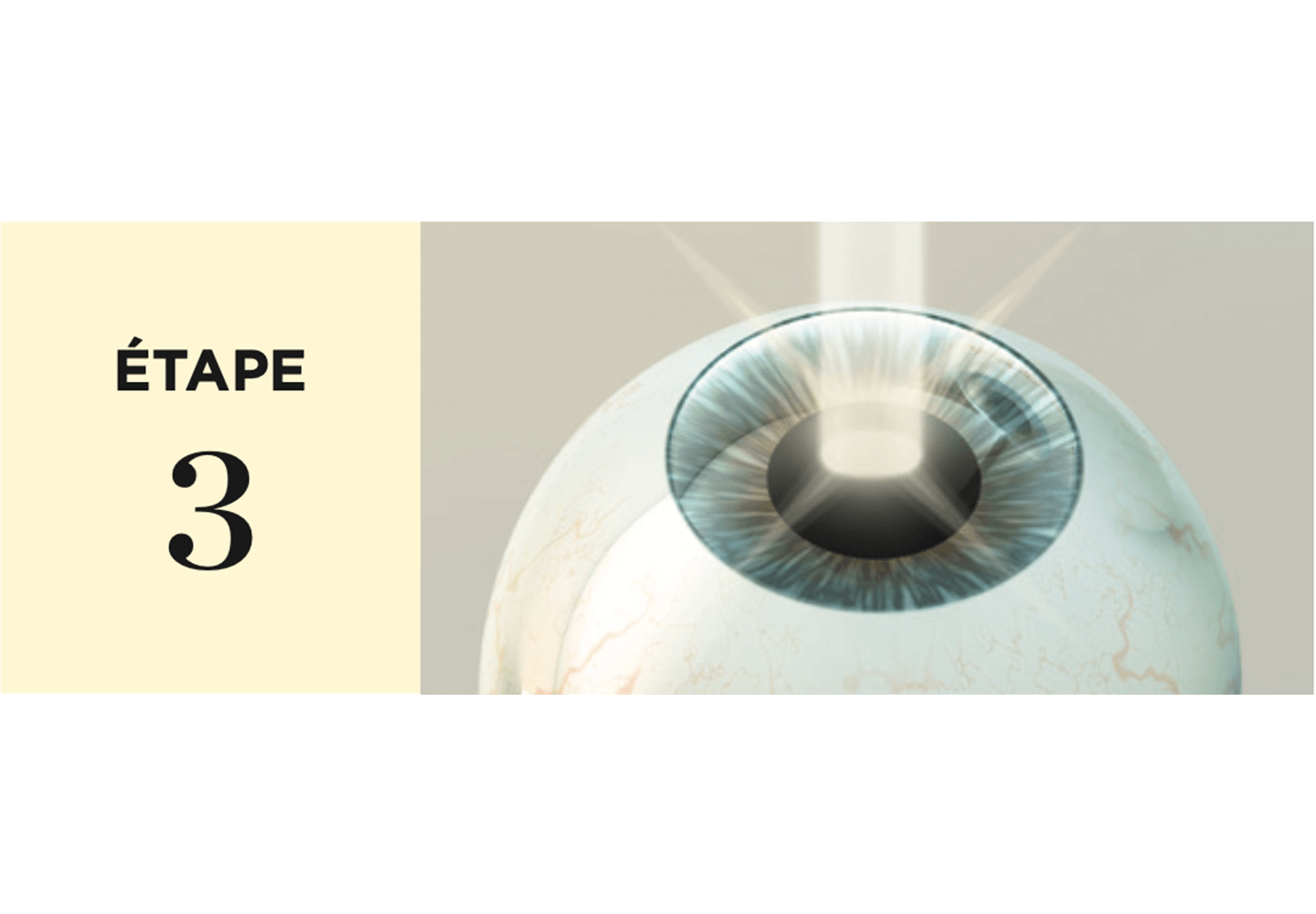 Faisceau laser qui est appliqué sur la cornée pour modifier sa courbure