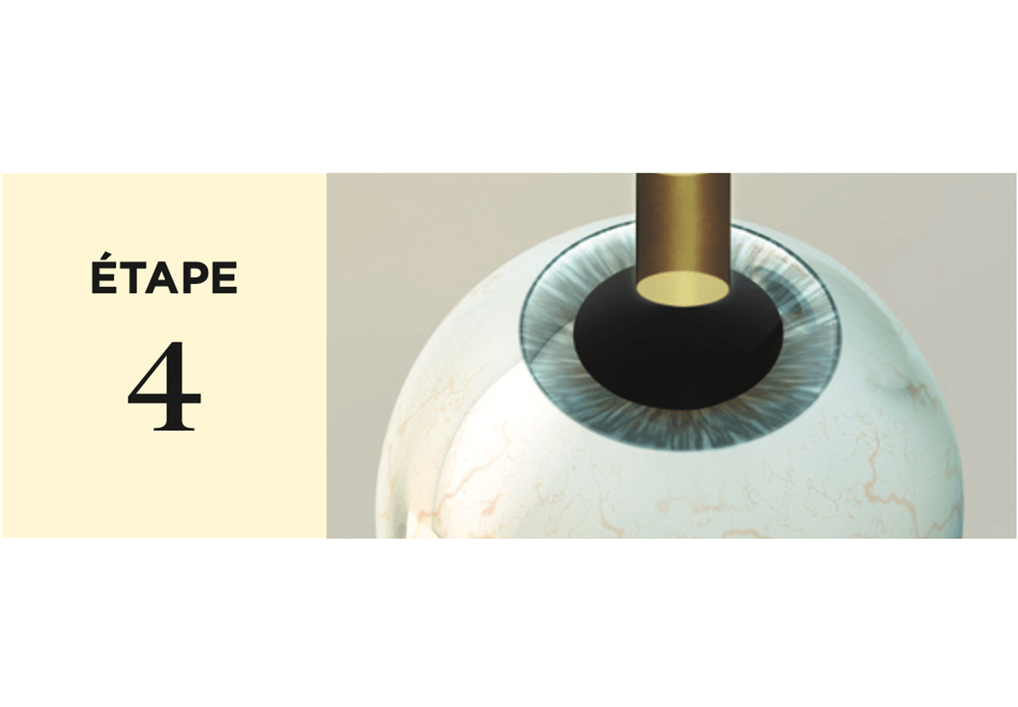 Le laser pulvérise des couches de cornée pour corriger sa courbure